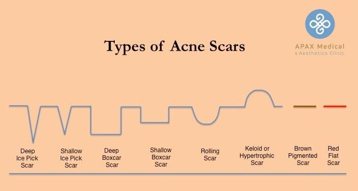 Types Of Acne Scars Live Scar Free Foundation